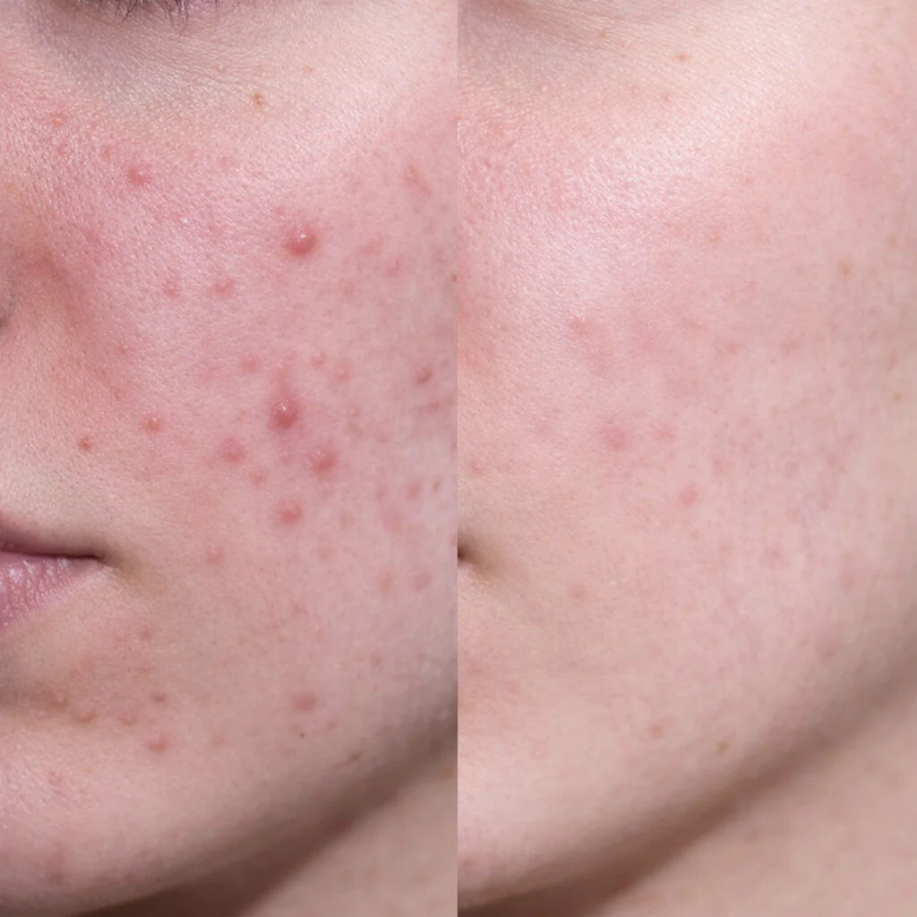 Gesichtscreme mit Salicylsäure gegen Pickel und Mitesser — Leichte, nicht fettende Salicylsäure Feuchtigkeitscreme für unreine und fettige Haut – reinigt Poren, reduziert Talg und klärt die Haut. - Image 6