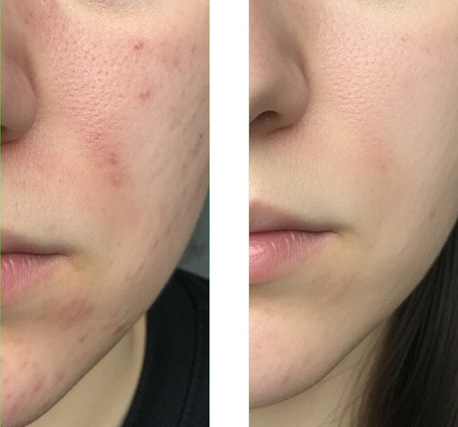 Salicylsäure-Gesichtsreinigung für fettige Haut — Salicylsäure-Cleanser/Reinigungsgel reduziert Mitesser, reguliert Talg und hinterlässt frische, reine Haut. Enthält Salicylsäure. - Image 6