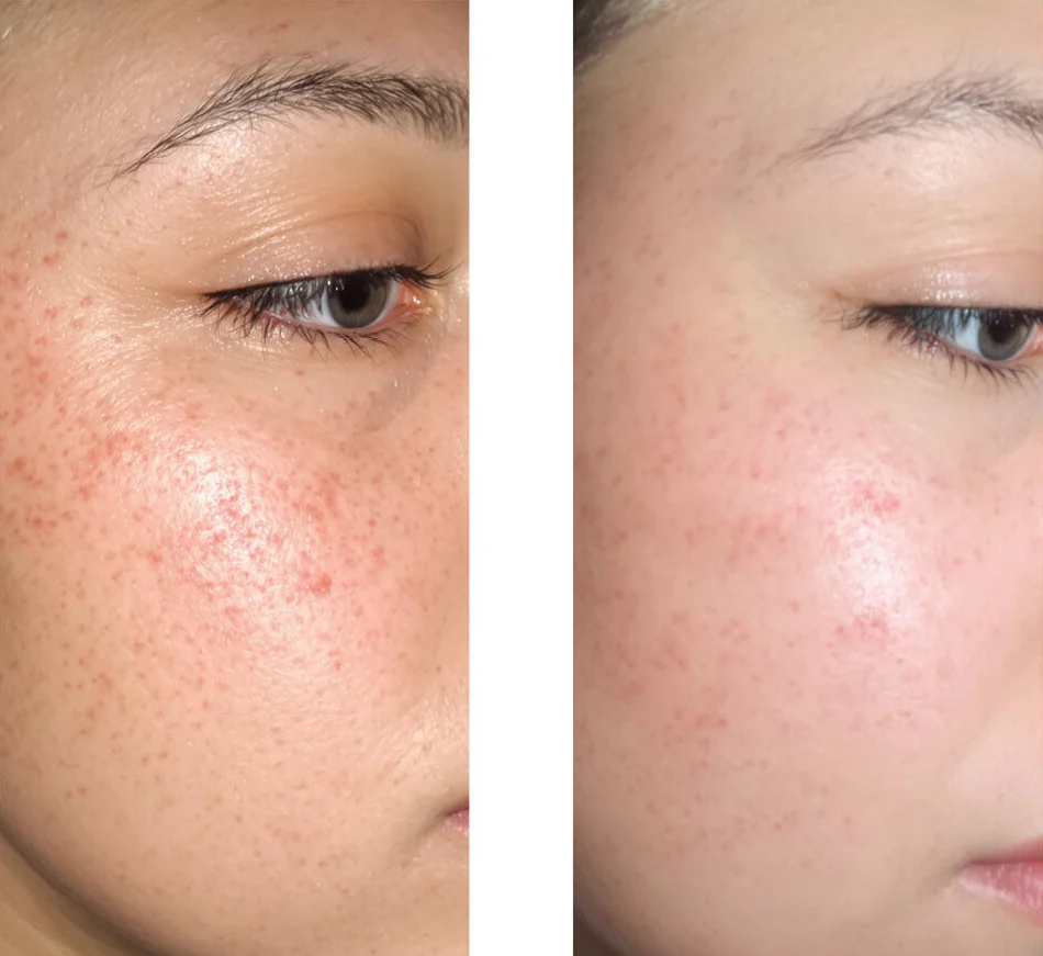 Salicylsäure Serum gegen Mitesser, fettige Haut und Poren — Salicylsäure Serum bei Mitessern, fettiger Haut und Poren. Mit Zink PCA, grünem Tee, Hyaluronsäure und Glycerin. - Image 6