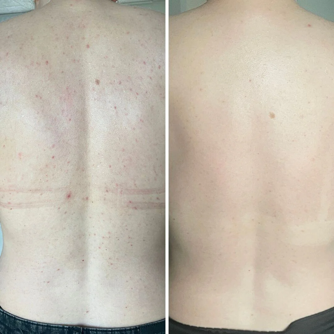 Salicylsäure-Spray gegen Pickel und verstopfte Poren — Spray gegen Pickel und unreine Haut. Mit 2 % Salicylsäure und Glykolsäure zur porentiefen Reinigung und glatterer Haut. - Image 6