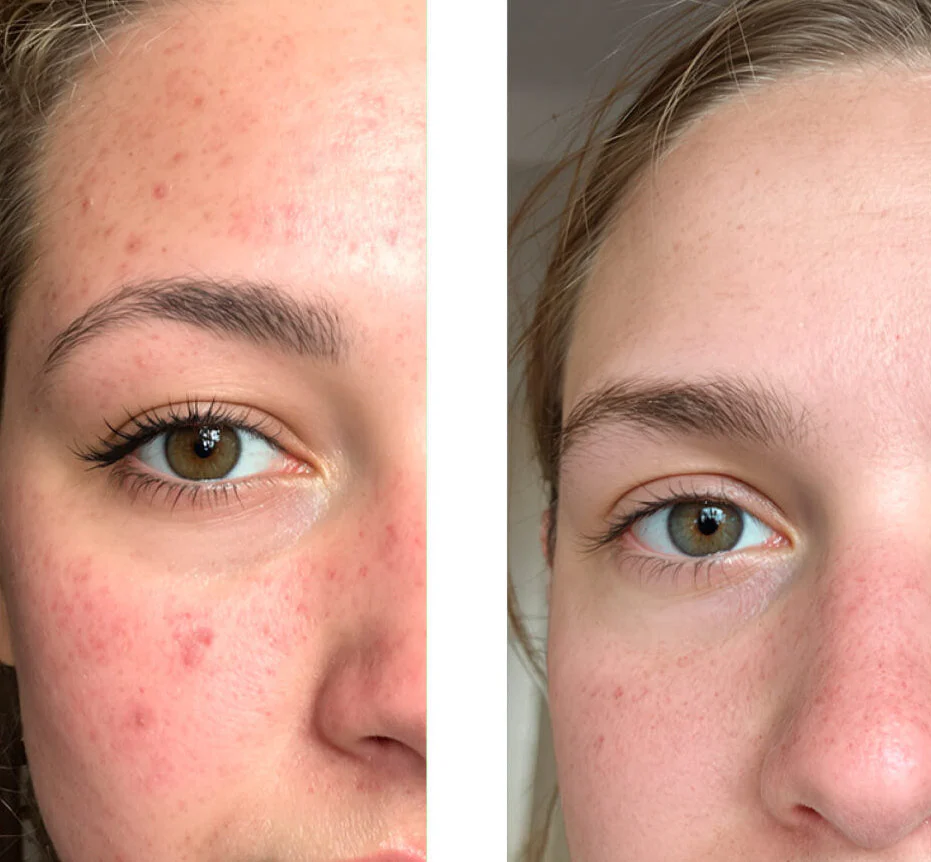 Salicylsäure-Toner gegen Pickel und große Poren — 2-in-1 Synergie: Porenreinigung & glatte Haut. AHA + BHA in einem Produkt! - Image 6